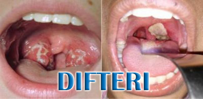 Apa itu Penyakit Difteri? Gejala, Penyebab, Obat, dan Cara Mencegahnya